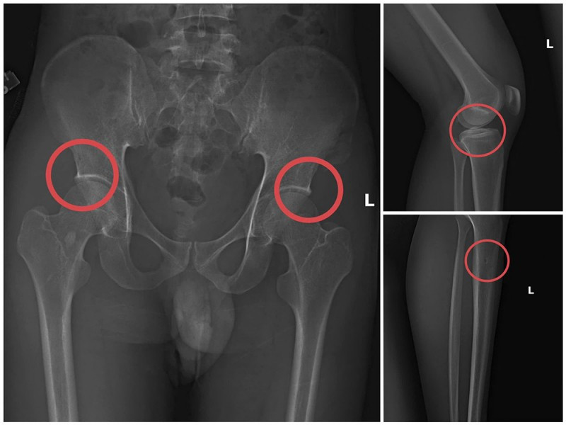 Đục xương để lừa đảo chiếm đoạt tiền bảo hiểm tại Ph&uacute; Thọ: Cuộc điều tra g&acirc;y chấn động - Ảnh 2.