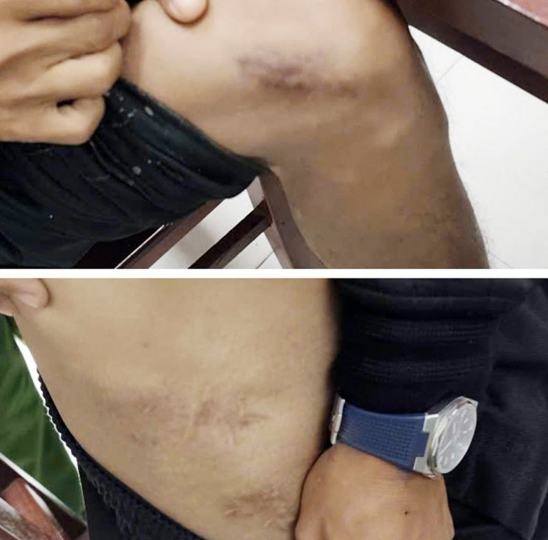 Đục xương để lừa đảo chiếm đoạt tiền bảo hiểm tại Ph&uacute; Thọ: Cuộc điều tra g&acirc;y chấn động - Ảnh 3.