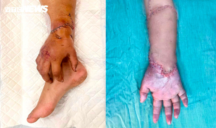 Bàn tay đứt lìa của mẹ bầu được nối lại Sau 2 tháng ' nuôi ' ở chân - Ảnh 1.