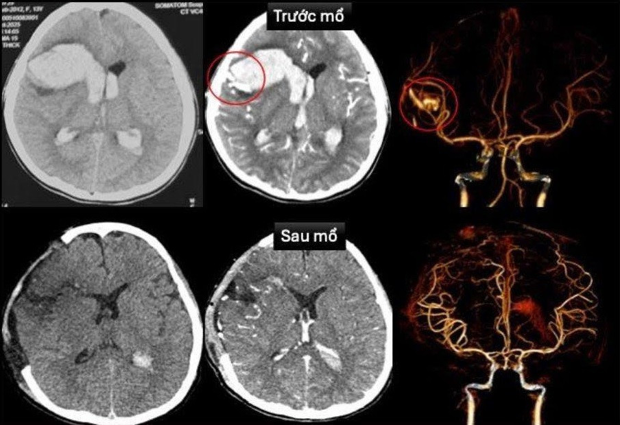 Hy Hữu Bé Gái 13 Tuổi Bị Đột Quỵ- Ảnh 1.