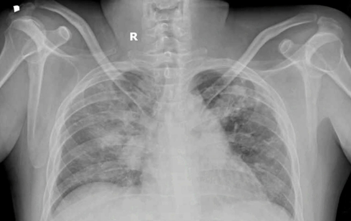 Điều trị thành ca bệnh thận mạn giai đoạn cuối không qua lọc máu- Ảnh 1.