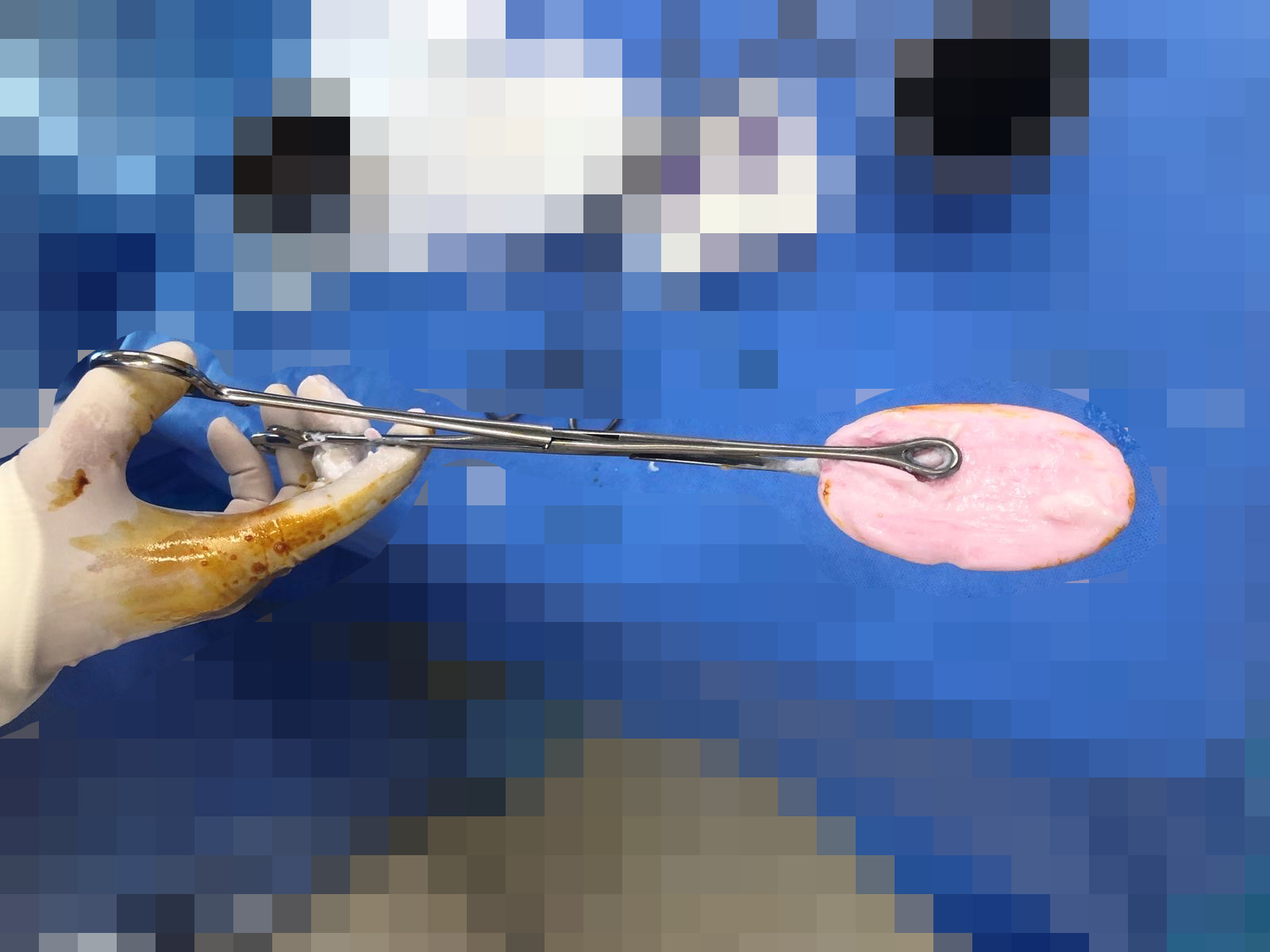 Bé gái 12 tuổi ở TP . HCM phải cấp cứu vì nhét xà phòng vào vùng kín - Ảnh 1.