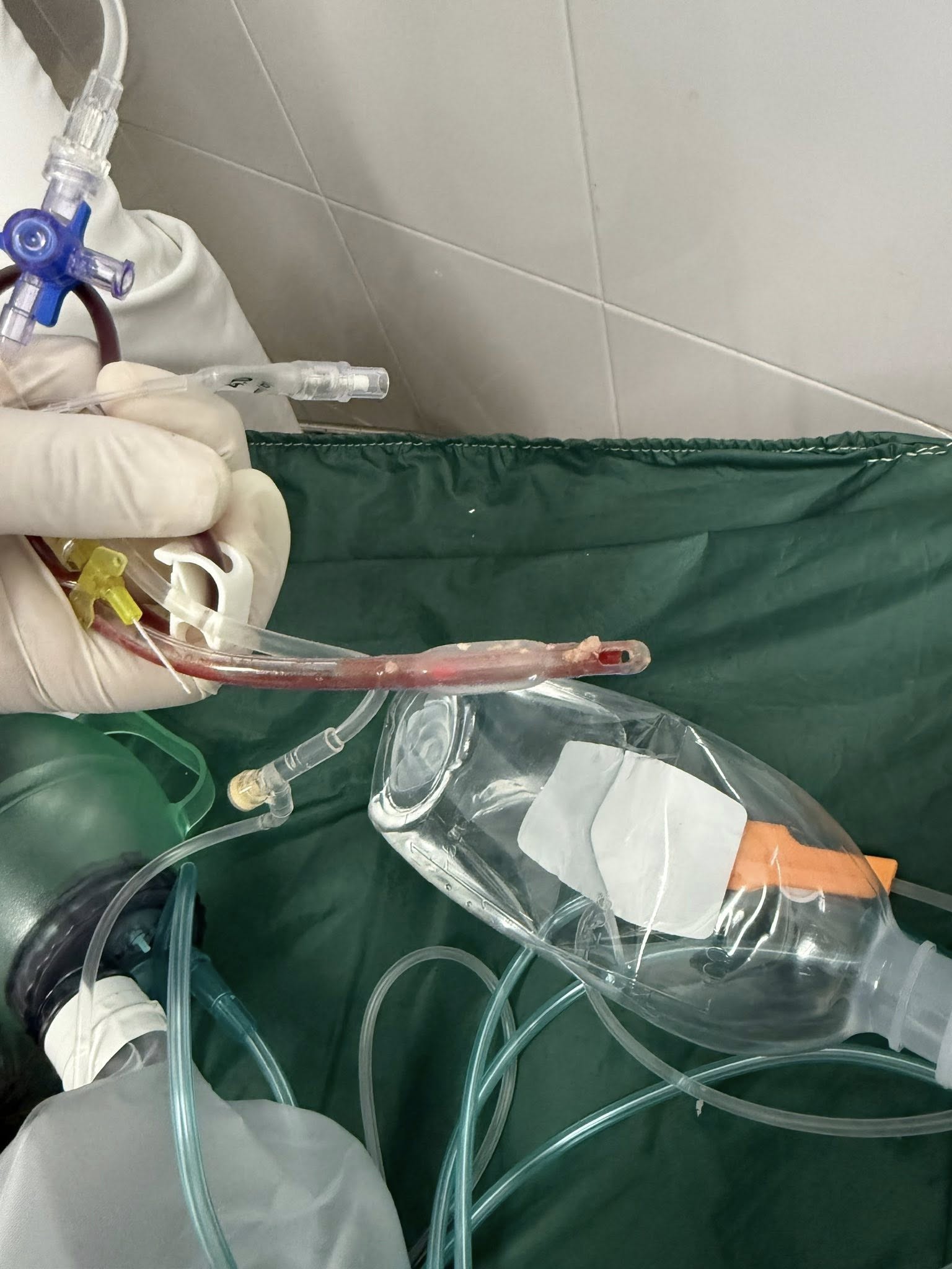 Bác Sĩ Cấp Cứu Đau Lòng Trước Bé Gái 3 Tuổi Sặc Thức Ăn Ở Nhà Trẻ Lời Cảnh Báo Từ Bác Sĩ Cấp Cứu Sau Vụ Bé Gái 3 Tuổi Tử Vong Vì Sặc Thức Ăn Tại Nhà Trẻ - Ảnh 1.