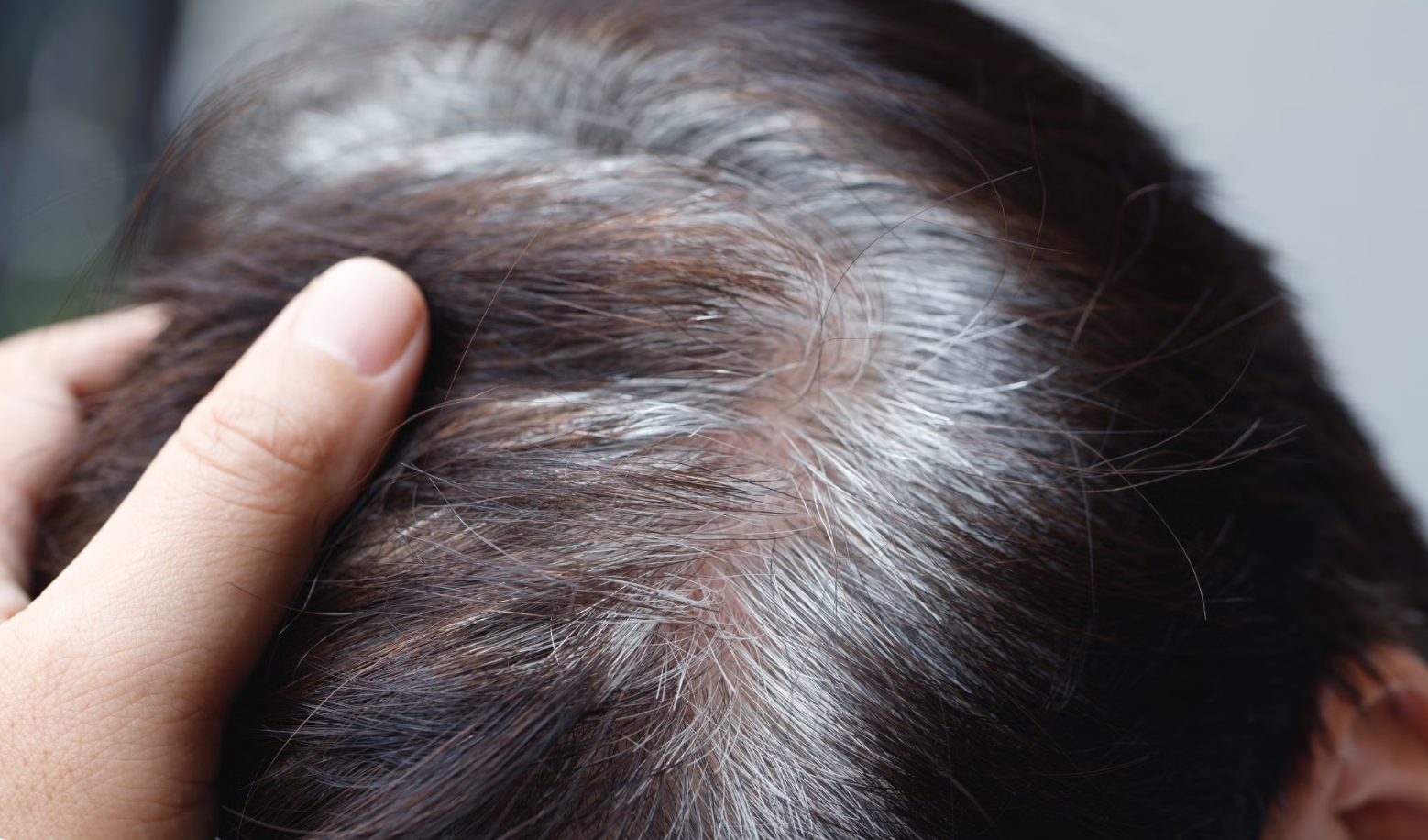 Bạc t&oacute;c đang trẻ h&oacute;a ở người Việt, c&oacute; b&eacute; 6 tuổi t&oacute;c đ&atilde; bạc trắng: B&aacute;c sĩ giải m&atilde; b&iacute; ẩn ph&iacute;a sau - Ảnh 3.