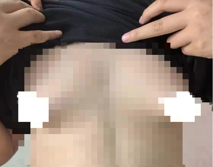 Ngực nam sinh 17 tuổi ngày càng to như thiếu nữ chỉ vì… trị mụn trứng cá sai cách - Ảnh 3.