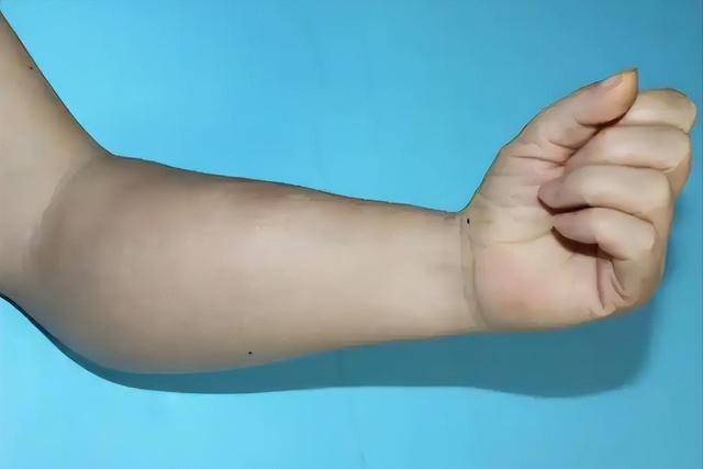 Bất kể nam hay nữ, nếu gặp phải 4 triệu chứng này ở cánh tay, rất có thể bạn bị ung thư: Dấu hiệu thứ 3 bị bỏ qua nhiều nhất- Ảnh 4. Bất kể nam hay nữ, nếu gặp phải 4 triệu chứng này ở cánh tay, rất có thể bạn bị ung thư: Dấu hiệu thứ 3 bị bỏ qua nhiều nhất- Ảnh 4.