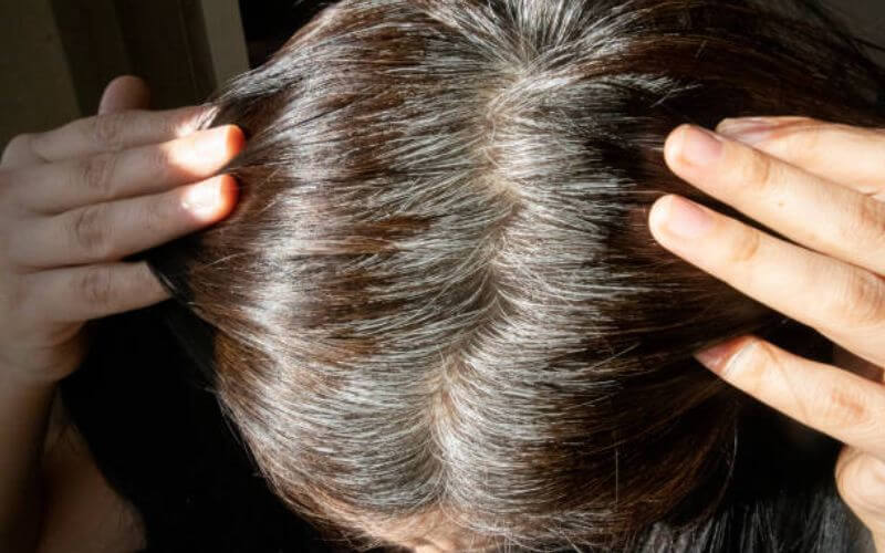 Bạc tóc đang trẻ hóa ở người Việt, có bé 6 tuổi tóc đã bạc trắng: Bác sĩ giải mã bí ẩn phía sau - Ảnh 2. Bạc tóc đang trẻ hóa ở người Việt, có bé 6 tuổi tóc đã bạc trắng: Bác sĩ giải mã bí ẩn phía sau - Ảnh 2.