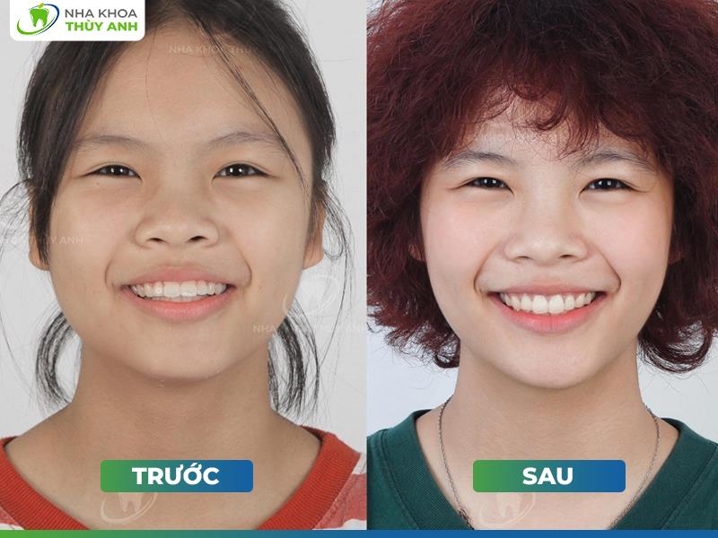 Hành Trình Kết Nối Nụ Cười Của Bác Sĩ Phương Thảo Tại Nha Khoa Thùy Anh - Ảnh 3. Hành Trình Kết Nối Nụ Cười Của Bác Sĩ Phương Thảo Tại Nha Khoa Thùy Anh - Ảnh 3.