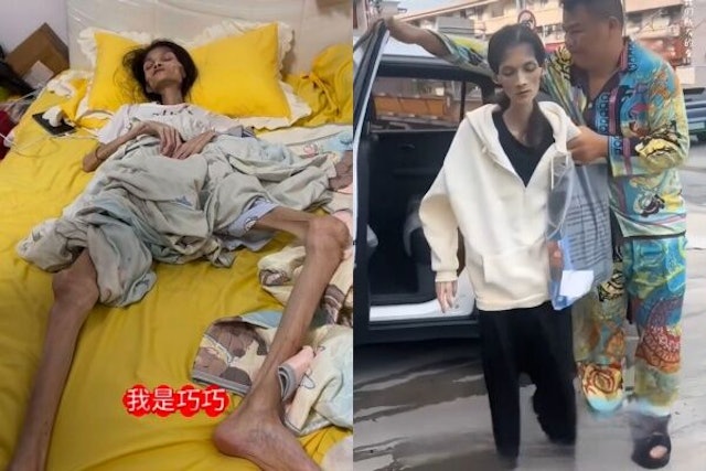 Nữ Tiktoker 27 tuổi qua đời vì chứng teo dạ dày, lúc cuối đời chỉ còn 17,5 kg: Mọi chuyện bắt đầu từ hoàn cảnh gia đình- Ảnh 2.