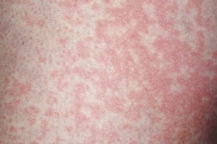 Người đ&agrave;n &ocirc;ng nhiễm nấm v&ugrave;ng k&iacute;n v&igrave; th&oacute;i quen nhiều người l&agrave;m với đồ l&oacute;t của m&igrave;nh- Ảnh 1.