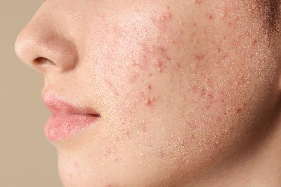 Trị th&acirc;m mụn thế n&agrave;o cho hiệu quả v&agrave; an to&agrave;n? G&oacute;c nh&igrave;n từ chuy&ecirc;n gia thẩm mỹ - Ảnh 1.