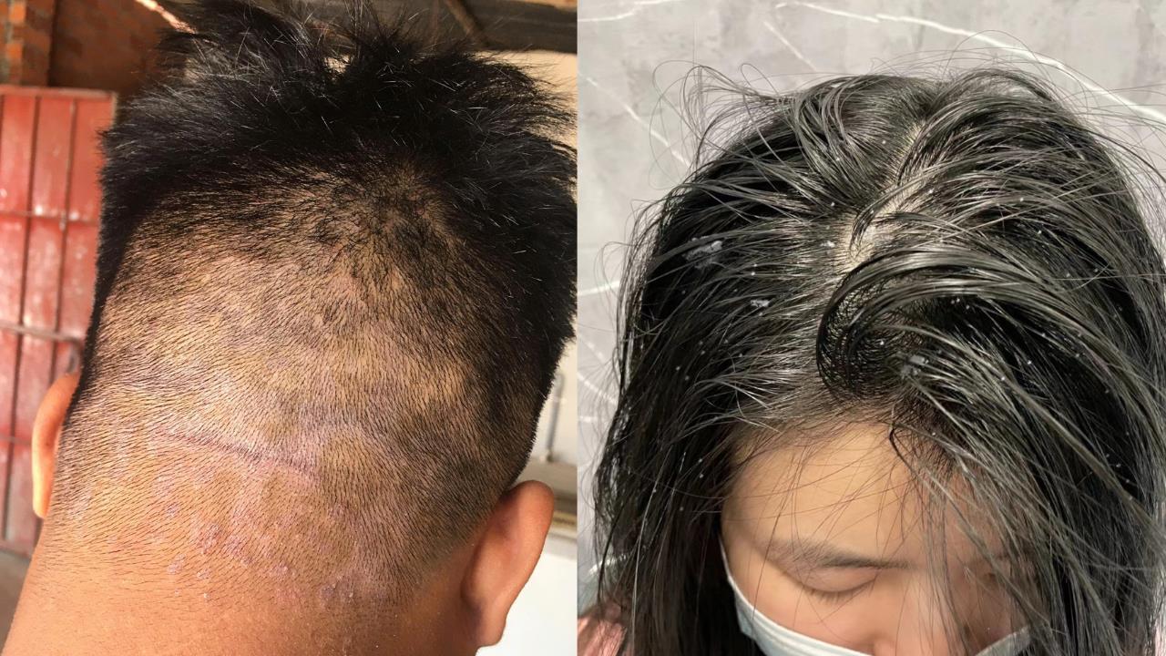 Gàu – ngứa – bết tóc mùa mưa bão: Giải pháp dịu nhẹ được nhiều chị em chia sẻ gần đây - Ảnh 2.