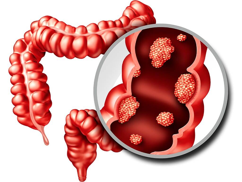 Muốn Ngăn Chặn Ung Thư Đại Tràng, Đây Là Việc Cần Làm Đầu Tiên - Ảnh 1. Muốn Ngăn Chặn Ung Thư Đại Tràng, Đây Là Việc Cần Làm Đầu Tiên - Ảnh 1.