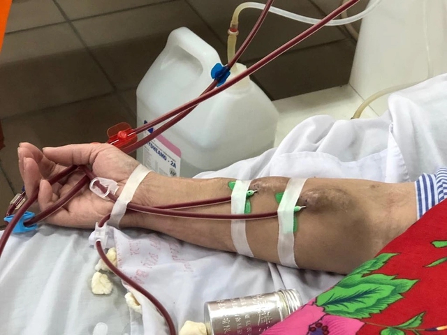 20 tuổi đã phải chạy thận cả đời, bác sĩ chỉ biết thốt lên đau xót: "Có dấu hiệu suy thận thế này sao không khám sớm"?- Ảnh 2.