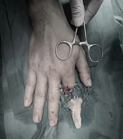 Ngón tay của thủy thủ "sống lại" sau 25 giờ bị đứt rời: Bác sĩ Việt Nam lập kỳ tích chưa từng có - Ảnh 1.