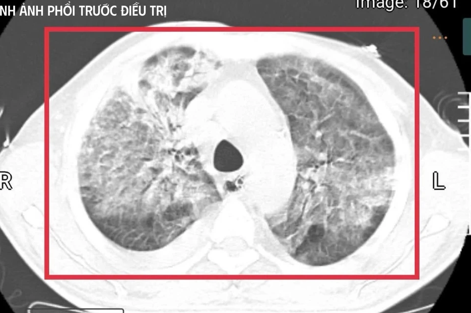 Nam Thanh Niên Ở Nghệ An Nhiễm Vi Khuẩn Truyền Nhiễm Chết Người, Gây Hôn Mê Sâu Nguy Kịch Sau Khi Trở Về Từ Thái Lan Vi Khuan An Thit Nguoi 2 1765251161360 17652511618352098309980
