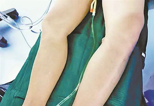 Bác sĩ lấy ra cục máu đông Bác sĩ lấy ra cục máu đông