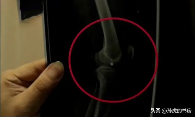 Nửa đêm đau nhói ở gối, người đàn ông phải nhập viện liền được bác sĩ yêu cầu: Gọi cảnh sát ngay lập tức! - Ảnh 2.