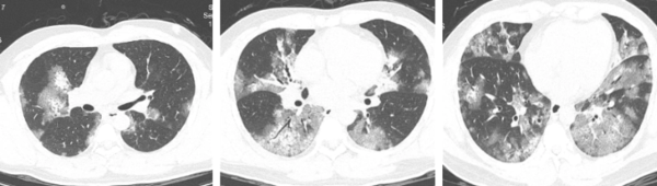 Cảnh báo từ ca "phổi trắng" do cúm A: Đừng chủ quan cho rằng "cúm chỉ sốt vài ngày, uống vài viên thuốc là khỏi"! - Ảnh 2. Cảnh báo từ ca "phổi trắng" do cúm A: Đừng chủ quan cho rằng "cúm chỉ sốt vài ngày, uống vài viên thuốc là khỏi"! - Ảnh 2.