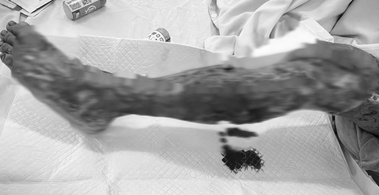 Tài công tàu biển bị "vi khuẩn ăn thịt người" tấn công- Ảnh 2. Tài công tàu biển bị "vi khuẩn ăn thịt người" tấn công- Ảnh 2.