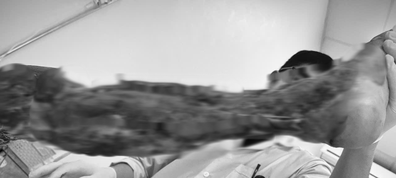 Tài công tàu biển bị "vi khuẩn ăn thịt người" tấn công- Ảnh 1. Tài công tàu biển bị "vi khuẩn ăn thịt người" tấn công- Ảnh 1.