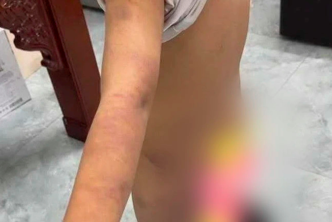 Làm rõ nghi vấn bạo hành nam sinh lớp 6 ở Hưng Yên - Ảnh 1. Làm rõ nghi vấn bạo hành nam sinh lớp 6 ở Hưng Yên - Ảnh 1.