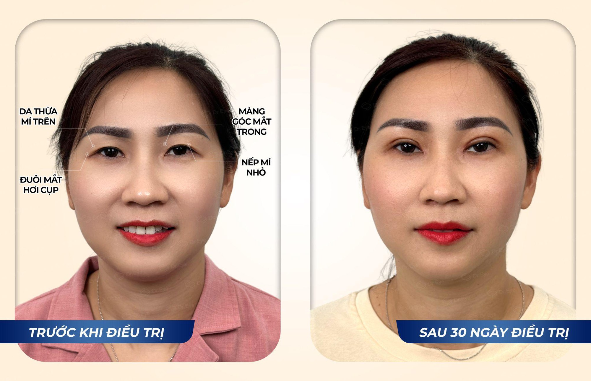 Hành trình trẻ hóa đôi mắt, lấy lại sự tự tin cho người mẹ hai con - chị Vòng Xuân Hạnh - Ảnh 2. Hành trình trẻ hóa đôi mắt, lấy lại sự tự tin cho người mẹ hai con - chị Vòng Xuân Hạnh - Ảnh 2.