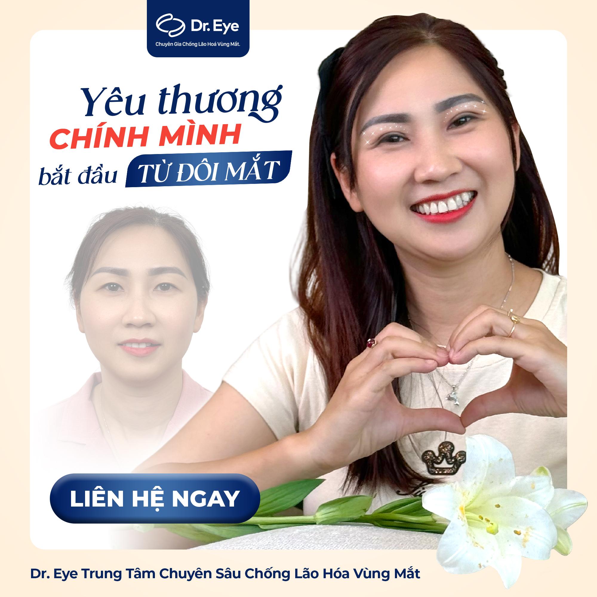 Hành trình trẻ hóa đôi mắt, lấy lại sự tự tin cho người mẹ hai con - chị Vòng Xuân Hạnh - Ảnh 3. Hành trình trẻ hóa đôi mắt, lấy lại sự tự tin cho người mẹ hai con - chị Vòng Xuân Hạnh - Ảnh 3.