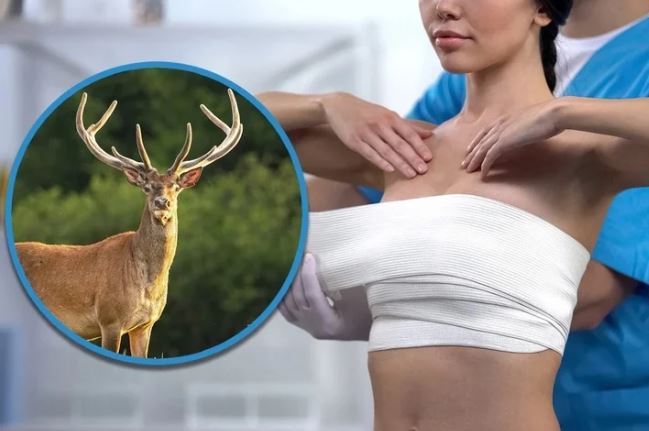 Bị biến dạng vòng 1 sau khi chi 8,4 tỷ đồng nâng ngực, cô gái sốc nặng khi phát hiện sự thật đáng sợ- Ảnh 1.