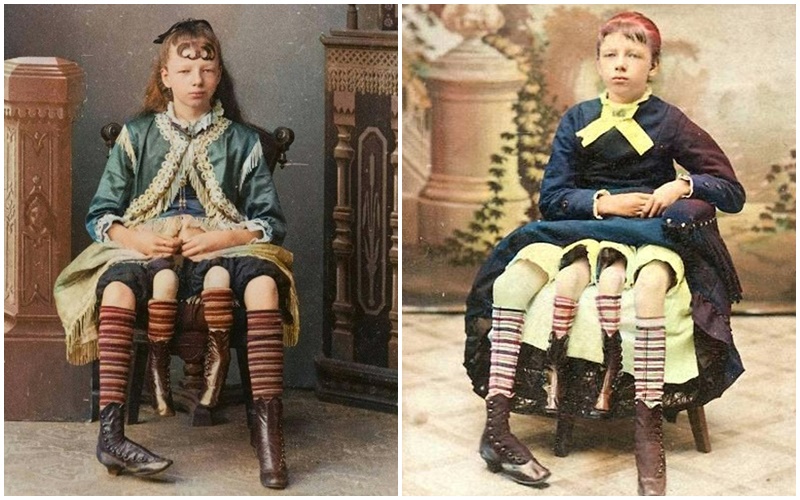 C&ocirc; g&aacute;i c&oacute; 4 ch&acirc;n, sở hữu cơ thể đặc biệt: 2 "v&ugrave;ng k&iacute;n", 2 xương chậu, sống cuộc đời trọn vẹn - Ảnh 2.