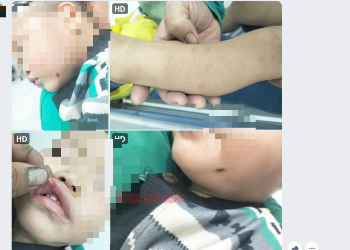 Bảo mẫu h&agrave;nh hạ trẻ ở Quảng Nam: Phẫn nộ tột độ, kh&ocirc;ng thể để t&aacute;i diễn!- Ảnh 2.