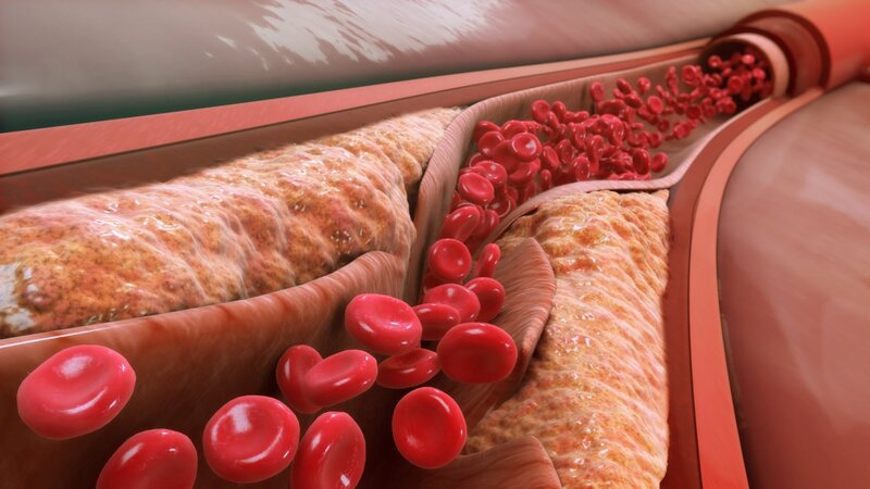 Đi bộ mà có 5 dấu hiệu này chứng tỏ cholesterol đang “chạm đỉnh nóc”, muốn tuổi thọ cao hay trẻ lâu cũng khó- Ảnh 1.