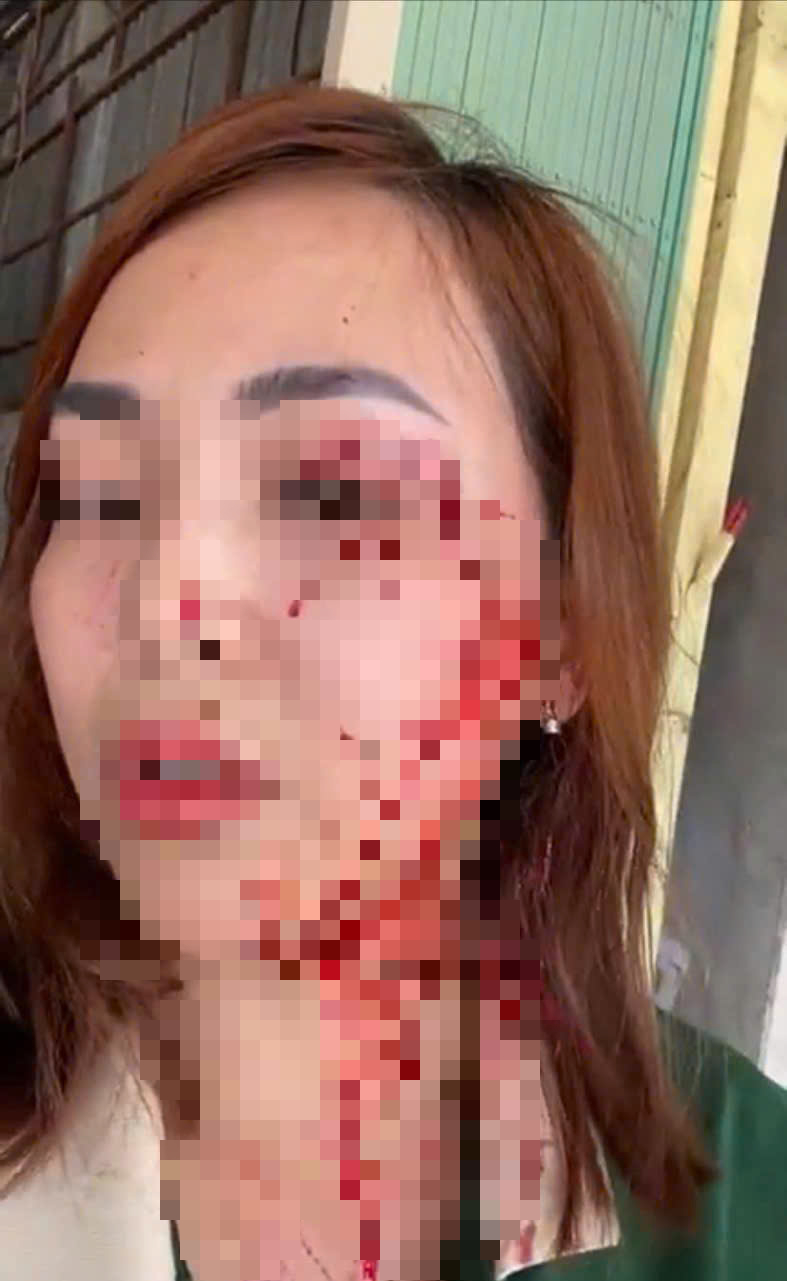 Khởi tố vụ phụ nữ bị rạch mặt ở Nha Trang do người lạ tấn công - Ảnh 1.