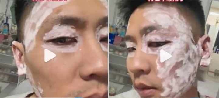 Mặt sưng vù sau khi lau bằng khăn giấy ở nhà hàng- Ảnh 1.