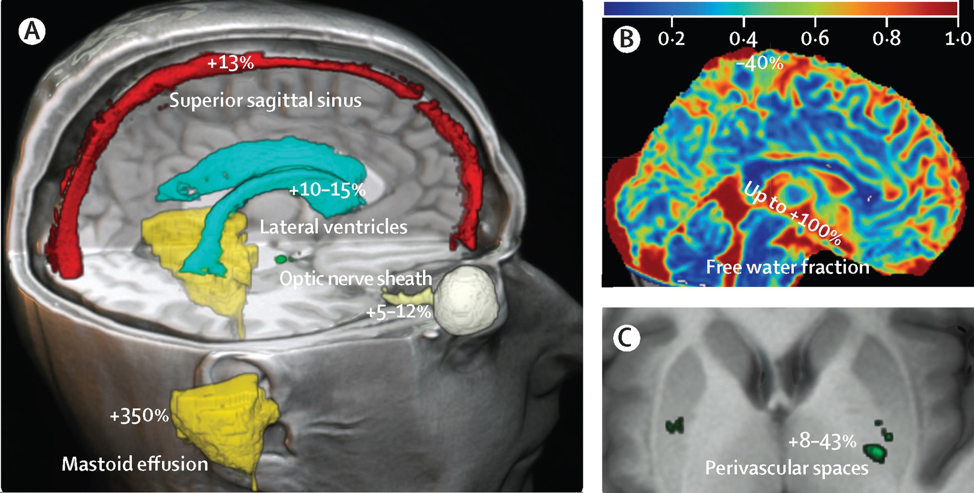 Qu&eacute;t n&atilde;o của 30 phi h&agrave;nh gia bằng MRI trước v&agrave; sau khi bay v&agrave;o vũ trụ, c&aacute;c chuy&ecirc;n gia c&oacute; ph&aacute;t hiện sốc- Ảnh 2.