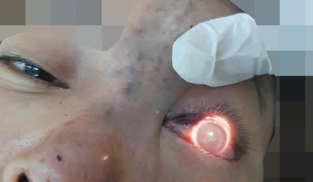 Nữ sinh 22 tuổi mắt kh&ocirc;ng nhắm k&iacute;n, chảy nước mắt li&ecirc;n tục v&igrave; th&oacute;i quen l&agrave;m đẹp "bất chấp" của nhiều người- Ảnh 3.