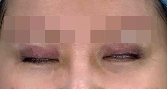 Nữ sinh 22 tuổi mắt kh&ocirc;ng nhắm k&iacute;n, chảy nước mắt li&ecirc;n tục v&igrave; th&oacute;i quen l&agrave;m đẹp "bất chấp" của nhiều người- Ảnh 1.