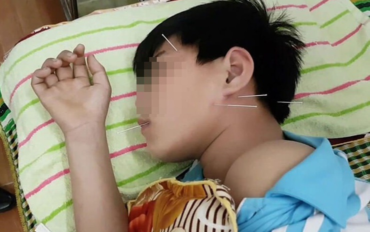 B&eacute; 5 tuổi bị liệt nửa mặt đột ngột: Cảnh b&aacute;o cha mẹ về căn bệnh trẻ c&oacute; thể gặp do nằm quạt, điều h&ograve;a trong m&ugrave;a h&egrave;- Ảnh 3.