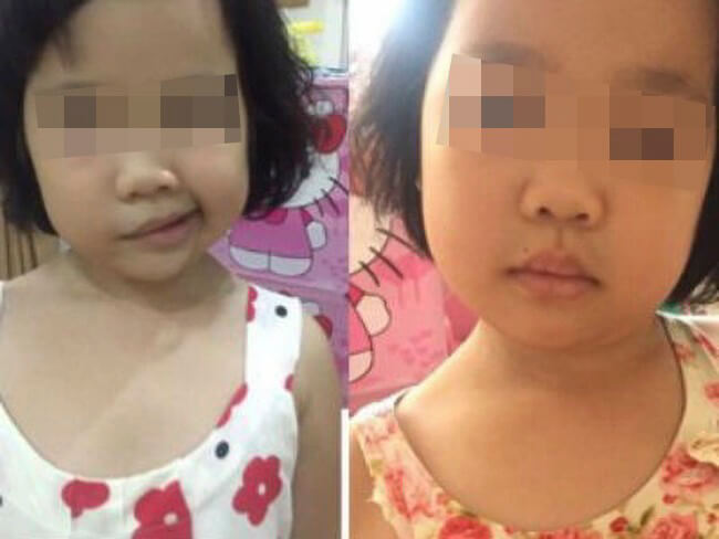 B&eacute; 5 tuổi bị liệt nửa mặt đột ngột: Cảnh b&aacute;o cha mẹ về căn bệnh trẻ c&oacute; thể gặp do nằm quạt, điều h&ograve;a trong m&ugrave;a h&egrave;- Ảnh 4.