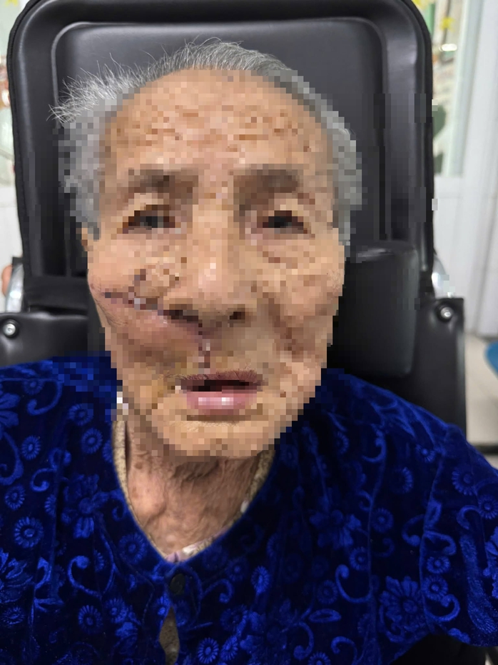 Gi&ograve;i "l&agrave;m tổ" trong khối u tr&ecirc;n mặt cụ b&agrave; ở Quảng Nam - Ảnh 2.