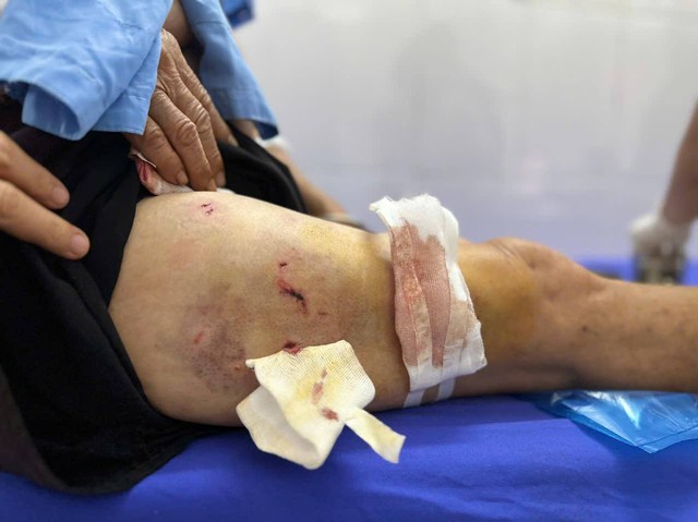 Cụ b&agrave; 77 tuổi ở Y&ecirc;n B&aacute;i bị ch&oacute; tấn c&ocirc;ng nghi&ecirc;m trọng , nhiều vết thương tr&ecirc;n cơ thể - Ảnh 2.