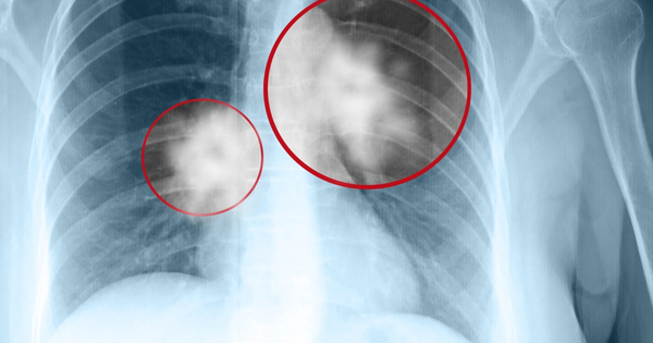 Không ngờ nhà bếp quen thuộc lại chứa "thủ phạm" gây ung thư phổi mà ít ai ngờ tới! - Ảnh 4.