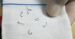 Sau khi cắt trĩ, người phụ nữ phải nhập viện nhổ đinh 8 lần suốt 10 năm- Ảnh 1.