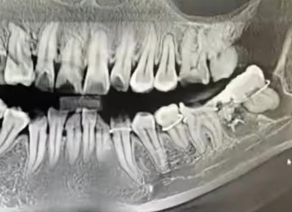 Sau khi cắt trĩ, người phụ nữ phải nhập viện nhổ đinh 8 lần suốt 10 năm- Ảnh 2.