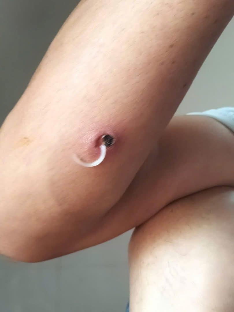 Cảnh b&aacute;o bệnh giun rồng xuất hiện tại một tỉnh ở Việt Nam- Ảnh 1.