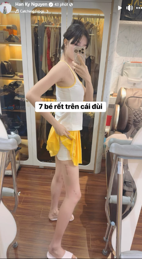 Kỳ H&acirc;n để lộ đ&ocirc;i ch&acirc;n đầy sẹo sau chấn thương g&atilde;y ch&acirc;n tr&ecirc;n s&acirc;n pickleball khiến d&acirc;n t&igrave;nh x&ocirc;n xao- Ảnh 1.