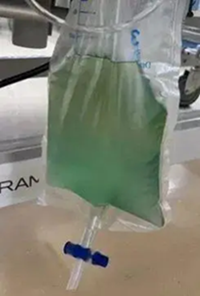 Nam thanh ni&ecirc;n 25 tuổi tiểu ra "nước xanh kỳ qu&aacute;i&rdquo;, h&ocirc;n m&ecirc; s&acirc;u v&igrave; tr&uacute;ng kịch độc thường thấy trong m&oacute;n ăn nhiều người Việt m&ecirc;- Ảnh 1.