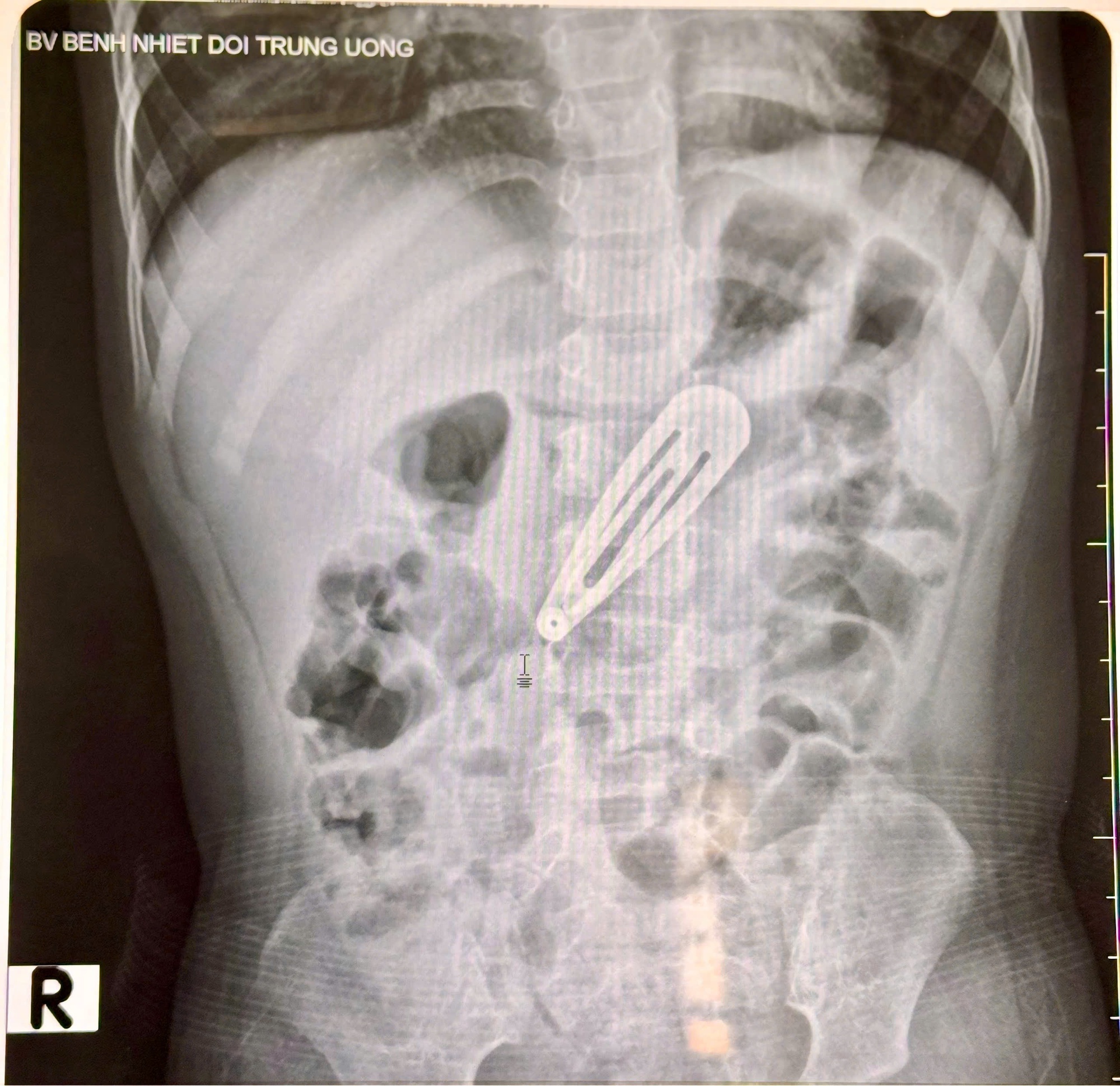 Hà Nội: Bé gái 21 tháng tuổi nhập viện vì trẻ nhỏ nuốt dị vật kẹp tóc kim lọai - Ảnh 2.