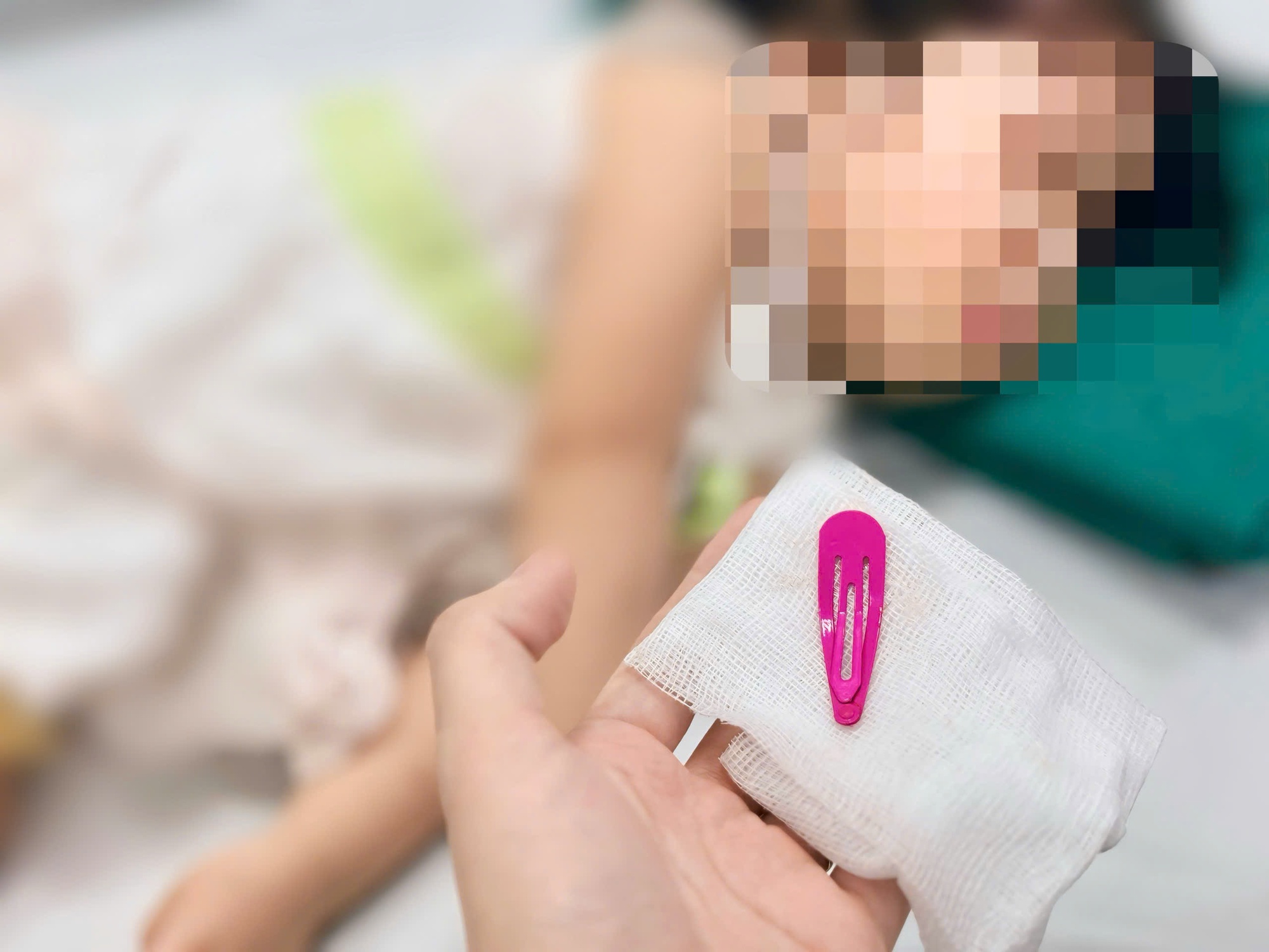 Hà Nội: Bé gái 21 tháng tuổi nhập viện vì trẻ nhỏ nuốt dị vật kẹp tóc kim lọai - Ảnh 3.