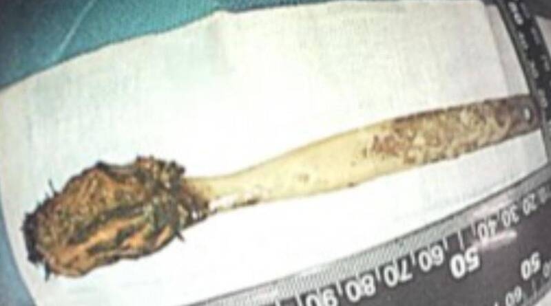 Đau ngực đi kh&aacute;m, b&aacute;c sĩ sốc nặng khi thấy thứ trong bụng người đ&agrave;n &ocirc;ng- Ảnh 1.